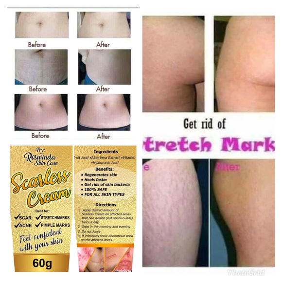 Scarless Cream Acne Stretch Mark Pimple Marks - Picture 1 of 8